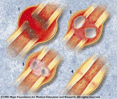 Bone Healing Process Remodeling Phase Bone reformed to original shape, structure, and