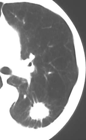 IVD Case Study: Lung Cancer Unmet Need CT is an expensive way to screen