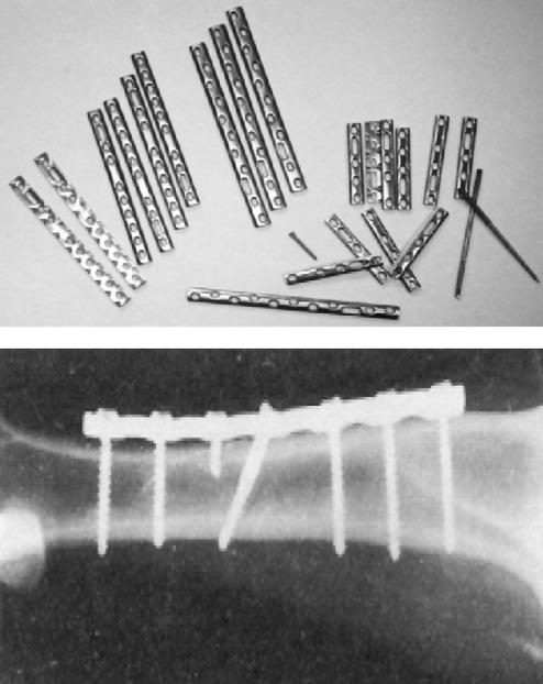 730 A. Azushima et al. / CIRP Annals - Manufacturing Technology 57 (2008) 716 735 Fig. 56. Plate implants made of nanostructured titanium [192].