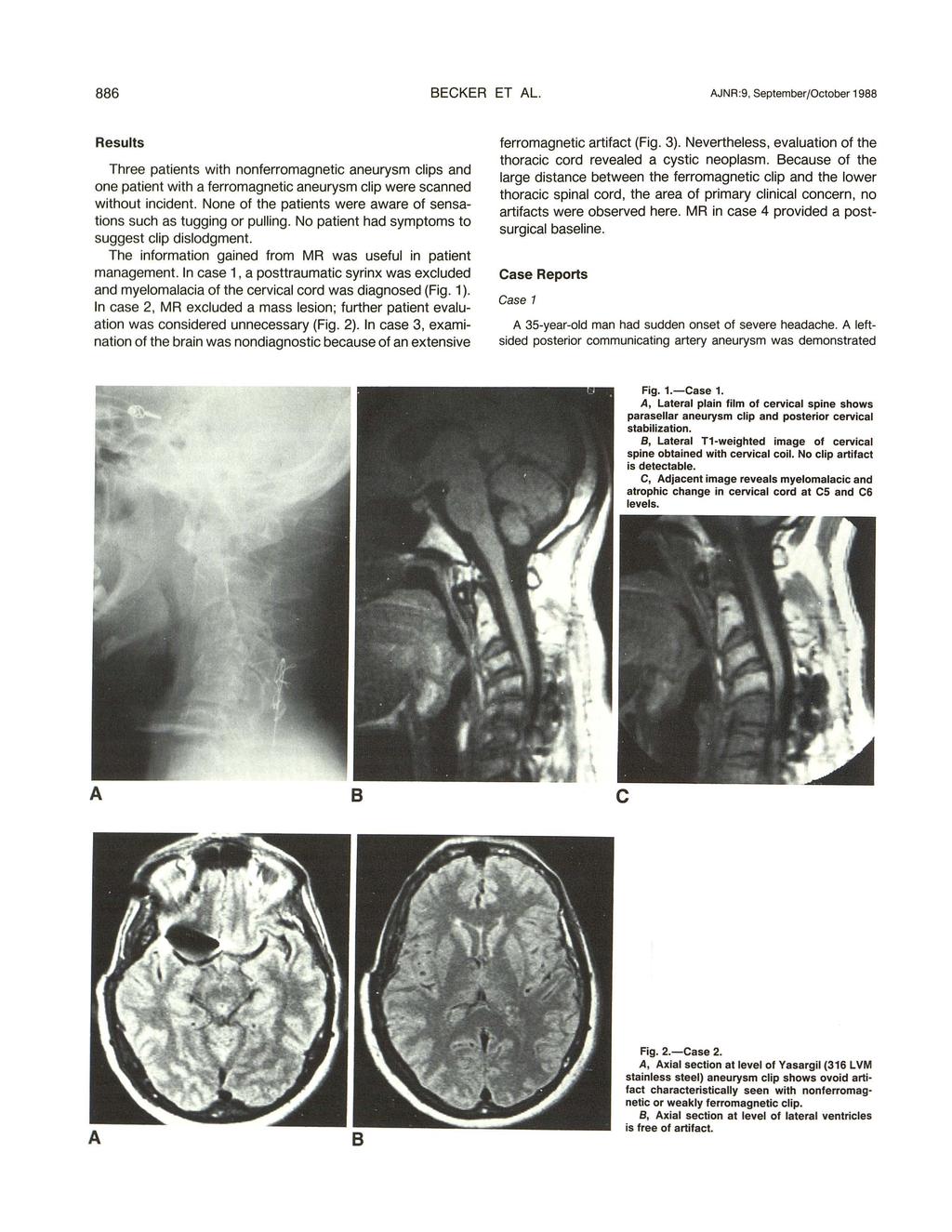 886 BECKER ET AL. AJNR :9, September/October 1988 Results Three patients with nonferromagnetic aneurysm clips and one patient with a ferromagnetic aneurysm clip were scanned without incident.