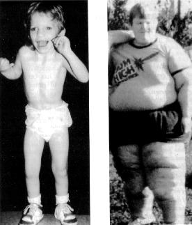 Prader-Willi Syndrome (PWS) Complex genetic neurobehavioral/metabolic disorder due to the loss or lack of expression of a set of genes on chromosome 15 Afflicts about 1:15,000 1:25,000 individuals