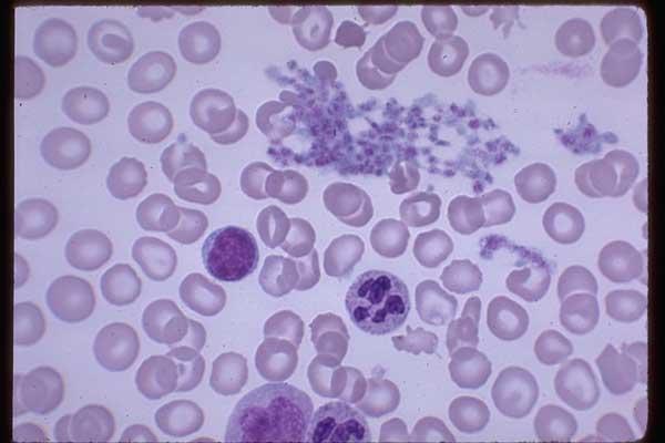 Thrombocytosis > 400000 1000000/ul malignancy myeloproliferative diseases polycythaemia