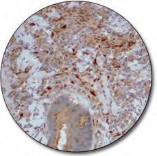 Thyroid follicular carcinoma (FFPE) stained with FLEX Anti- Thyroglobulin, Code GA509, on Dako Omnis.