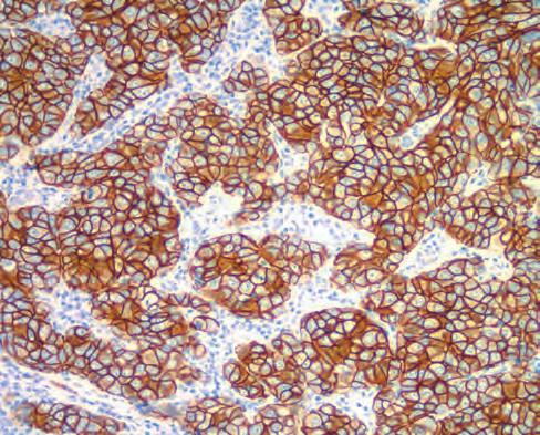 HercepTest Kits HercepTest is a semi-quantitative immunohistochemical assay for determination of HER2 protein (c-erbb-2 oncoprotein) overexpression in breast cancer tissues routinely processed for