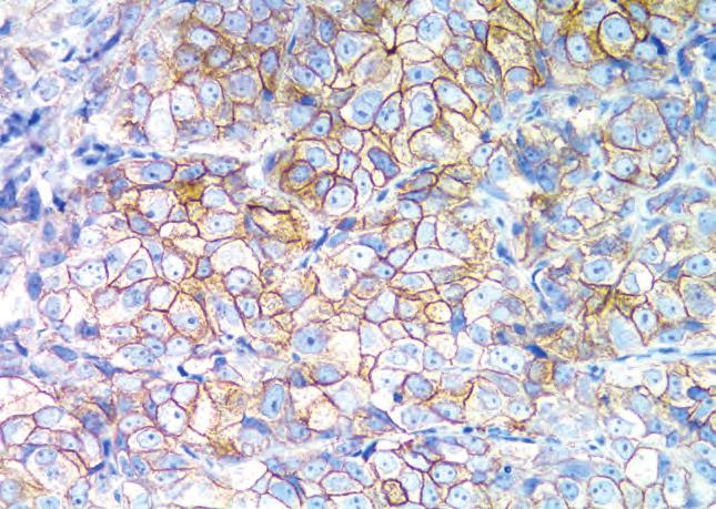 staining is observed, or faint membrane staining present in less than 10% of the tumor cells.