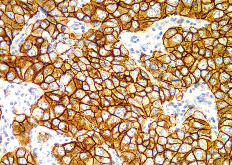 The cells exhibit incomplete membrane staining.