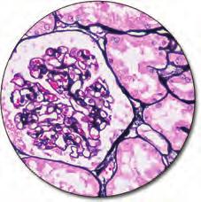 Fungi and Pneumocystis jiroveci are stained black while other tissue elements are stained pink. This stain is not recommended for cytology specimens.