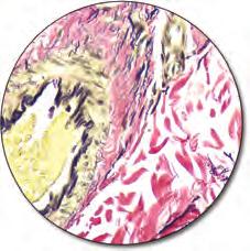 This stain demonstrates amyloid in pink to dark pink with light (bright field) microscopy or the characteristic apple green bi-refringence with polarized light.