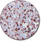 CD1a C IR069 Clone 010 60 tests, 12 ml Thymoma (FFPE) stained with FLEX Anti-