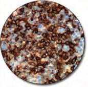 ml B-cell chronic lymphatic leukemia (FFPE) stained with FLEX Anti-CD45,