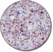 CD56 C IR628 Clone 123C3 60 tests, 12 ml Small cell carcinoma (FFPE)