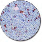 Hodgkin lymphoma (LP subtype) (FFPE) stained with FLEX Anti-CD57, Code