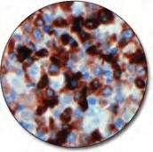 CD68 C IR609 Clone KP1 60 tests, 12 ml Acute myeloid leukemia (FAB Type