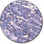 IHC Advanced Staining Solutions Carcinoids (FFPE) stained with FLEX Anti- CDX2, Code