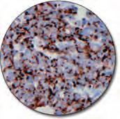 carcinoma (FFPE) stained with FLEX Anti-Cytokeratin 18, Code IR618/ IS618.