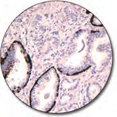 (FFPE) stained with FLEX Anti-Cytokeratin 19, Code IR615/ IS615.