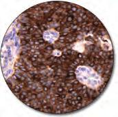 lymphoma (FFPE) stained with FLEX Anti-IgD, Code IR517/ IS517.