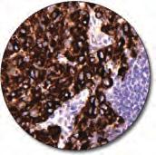 Melan-A C IR633 Clone A103 60 tests, 12 ml Granulosa cell tumor (FFPE) stained with