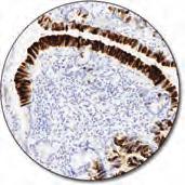 Melanosome C IR052 Clone HMB-45 60 tests, 12 ml Classic Hodgkin's lymphoma, (FFPE)