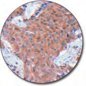 tumor (FFPE) stained with FLEX Anti- Myogenin, Code IR067/IS067.