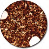 carcinoma (FFPE) stained with FLEX Anti-Neurofilament Protein, Code