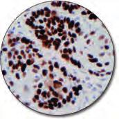Nucleophosmin C IR652 Clone 376 60 tests, 12 ml Acute myeloid leukemia