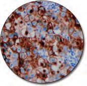 Transitional cell carcinoma (FFPE) stained with FLEX Anti-p53 Protein, Code