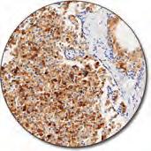 12 ml Colon adenocarcinoma (FFPE) with loss of PMS2 protein stained with FLEX Anti-PMS2, Code IR087.