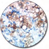 stained with FLEX Anti-Renal Cell Carcinoma Marker, Code IR075/IS075.