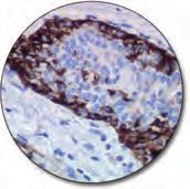Staining Solutions Prostatic adenocarcinoma (FFPE) stained with FLEX Anti-PSA, Code IR514/IS514.