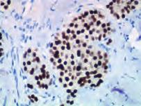 Breast ductal carcinoma stained with Anti-Gross Cystic Disease Fluid Protein-15, Code IR077/IS077.