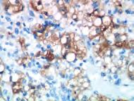 Protein DO-7 113 Renal Cell Carcinoma Marker SPM314 113 S100 Polyclonal 113 S100 + Tyrosinase + Melan-A