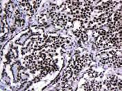 110 Podoplanin D2-40 74 Smooth Muscle Actin 1A4 117 Vimentin V9 117 Wilms Tumor 1 Protein 6F-H2 Uterine leiomyoma stained with Anti-Desmin, Code