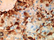 Mesothelioma stained with Anti-Wilms Tumor 1 Protein, Code IR055/IS055.