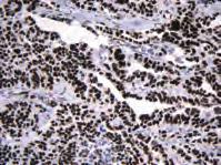 Prostate adenocarcinoma (FPPE) stained with FLEX Anti-Prostein, Code IR088.