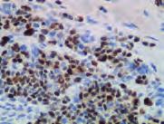 Tumor 1 Protein 6F-H2 Melanoma stained with Anti-Melan-A, Code IR633/IR633. Melanoma stained with Anti-Melanosome, Code IR052/IS052.