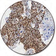 cell lymphomas. Breast ductal carcinoma (FFPE) stained with FLEX Anti-EMA, Code IR629/IS629.