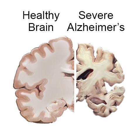 Scientists don t yet fuy undestand what causes Alzheime s disease.