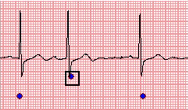 Untagging Normal Heartbeats The program may mistakenly tag a normal heartbeat as abnormal. Nobody is perfect!