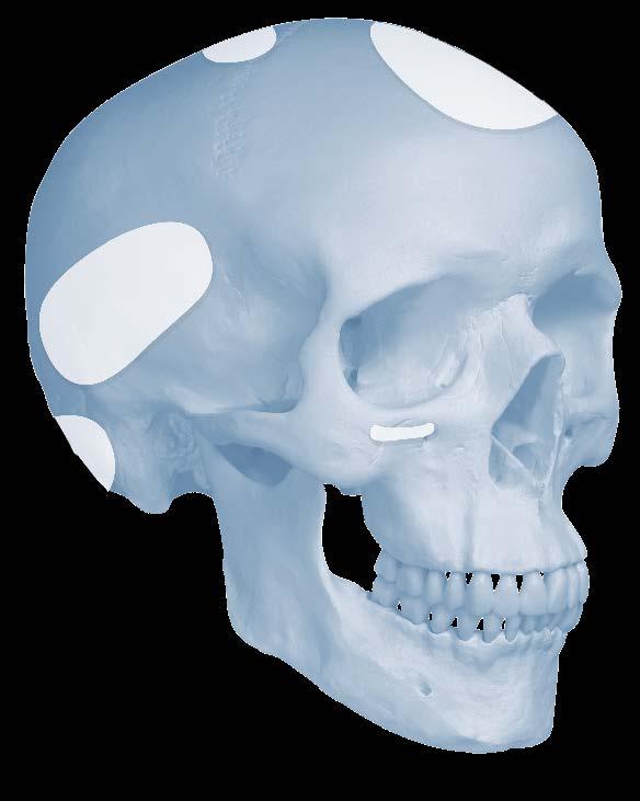CRANIOS REINFORCED BONE VOID FILLER Indications CRANIOS REINFORCED Fast Set Putty and CRANIOS REINFORCED are indicated for repairing or filling cranial defects and craniotomy cuts with a surface area