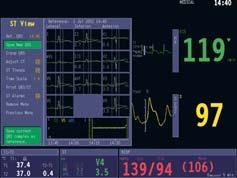 of patient s ischemic events Fully printable 12-lead diagnostic report EEG, AEP and BIS Up to four