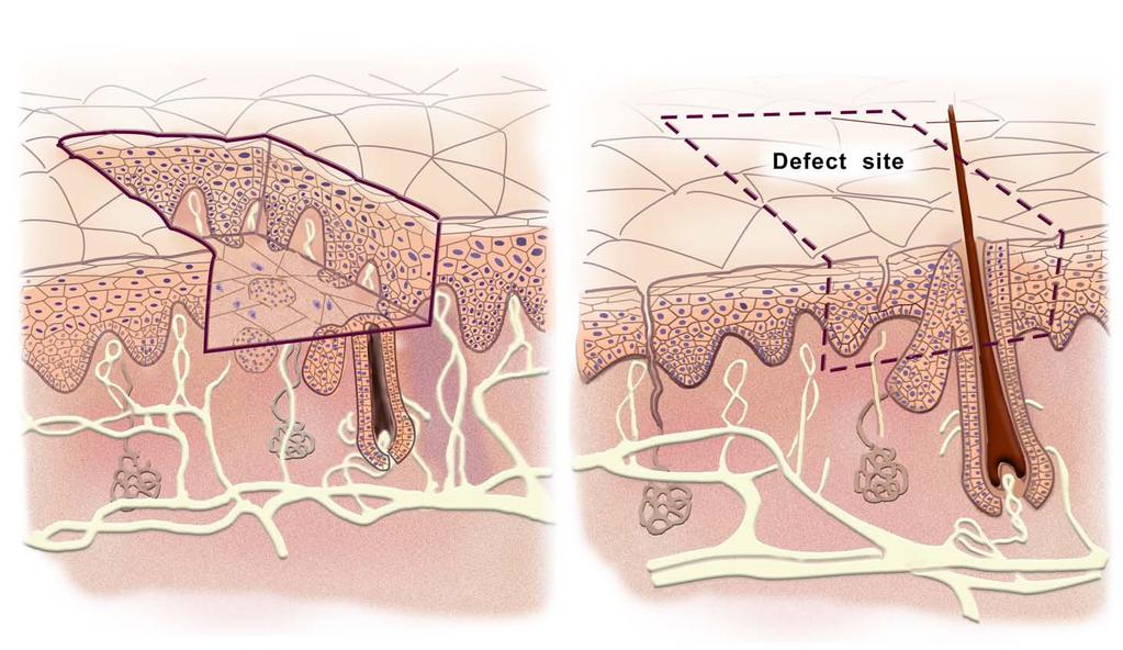 Skin: reversible injury Epidermis lost. Dermis intact. Figure by MIT OCW.