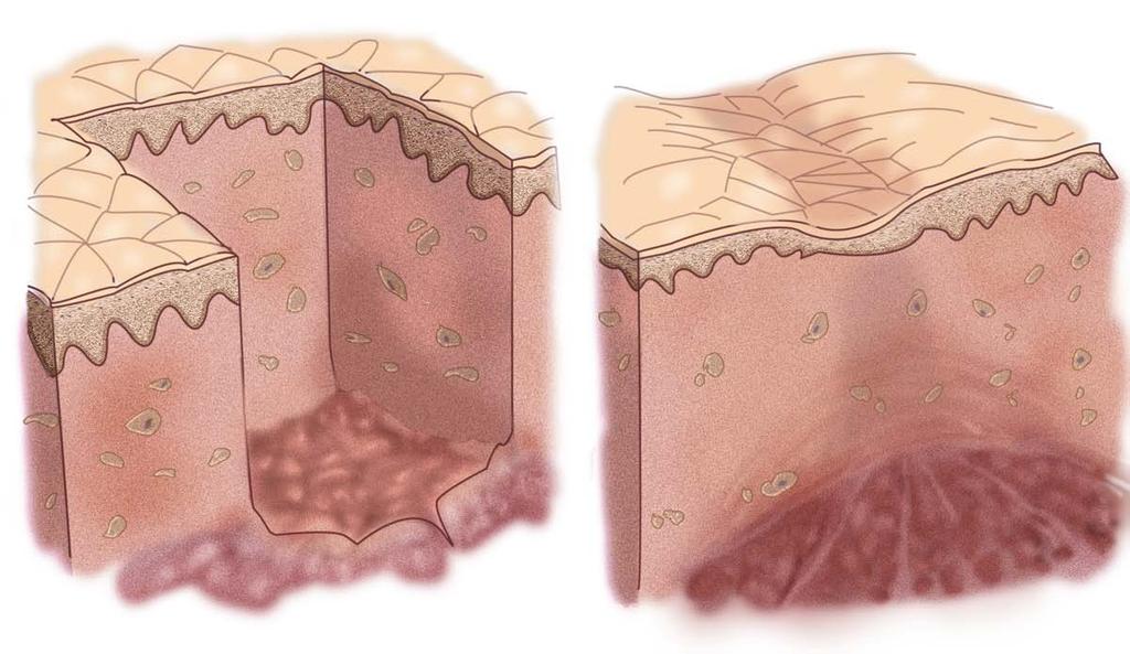 Skin: Irreversible injury spontaneous healing of fullthickness skin excision by contraction and scar formation Scar Epidermis and dermis both Closure.