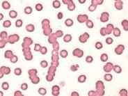 Rouleaux or red cells result from a stacking of erythrocytes that adhere in a coin-link fashion giving the appearance of agglutination.