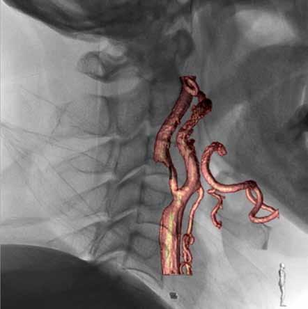 Figure 1. 3D roadmapping image in the lateral view demonstrating the internal carotid artery stenosis and bone structures. 1a Figure 1a.