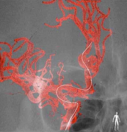 2a Figure 2. 3D roadmapping image of right ICA in the slight oblique anterior view demonstrating a distal ACA aneurysm. Figure 2a.