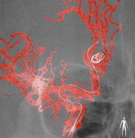 A platinum coil (GDC 10 soft SR) was released within the aneurysm. 2b Case 2 A 64-year-old male presented with sudden headache and nausea and proved to have developed a subarachnoid hemorrhage.