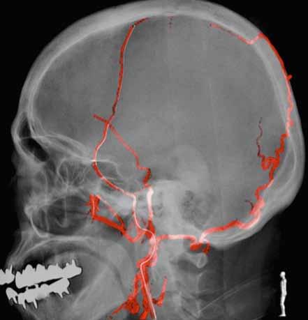 3c should be performed at an angle that ensures identification of the dome, neck and parent artery of the aneurysm.