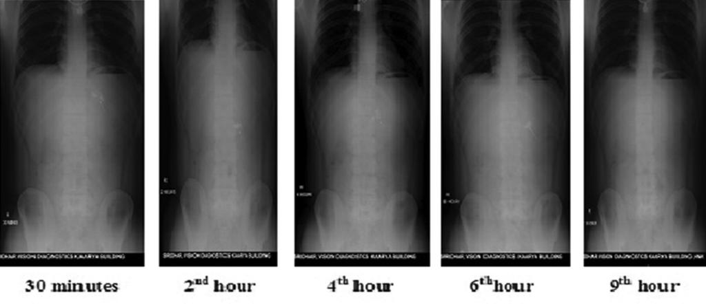 Figure 6: Radiographic pictures of human volunteers taken at different time intervals was studied by FTIR spectroscopy which suggested that there is no chemical interaction between drug and