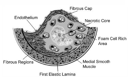 Figure 1.1. Diagram of the various components of an atherosclerotic lesion, including the necrotic core, foam cells, and fibrous regions.
